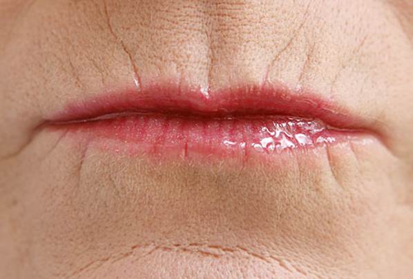 Lip lines can be treated