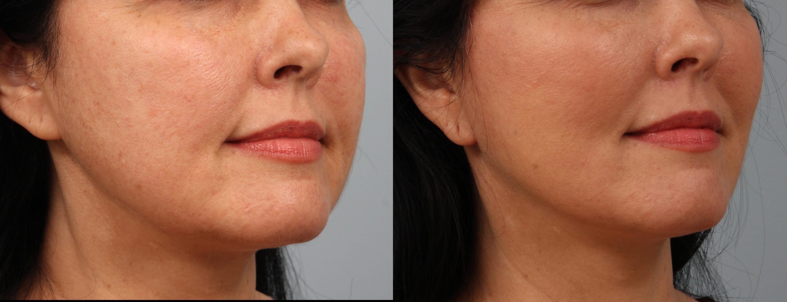 Buccal Fat Pad Removal San Francisco