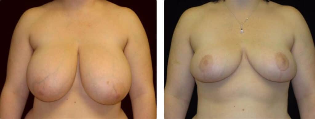 Breast Reduction before and after photo