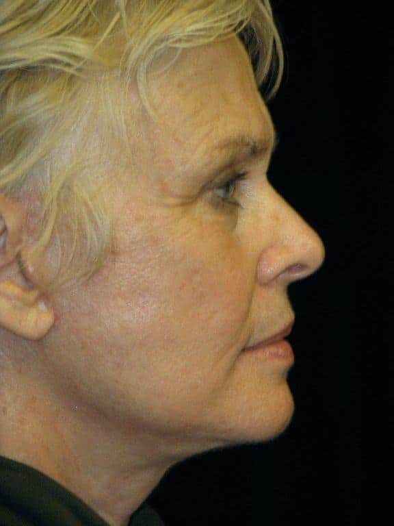 Patient after neck lift surgery combined with a lower facelift.