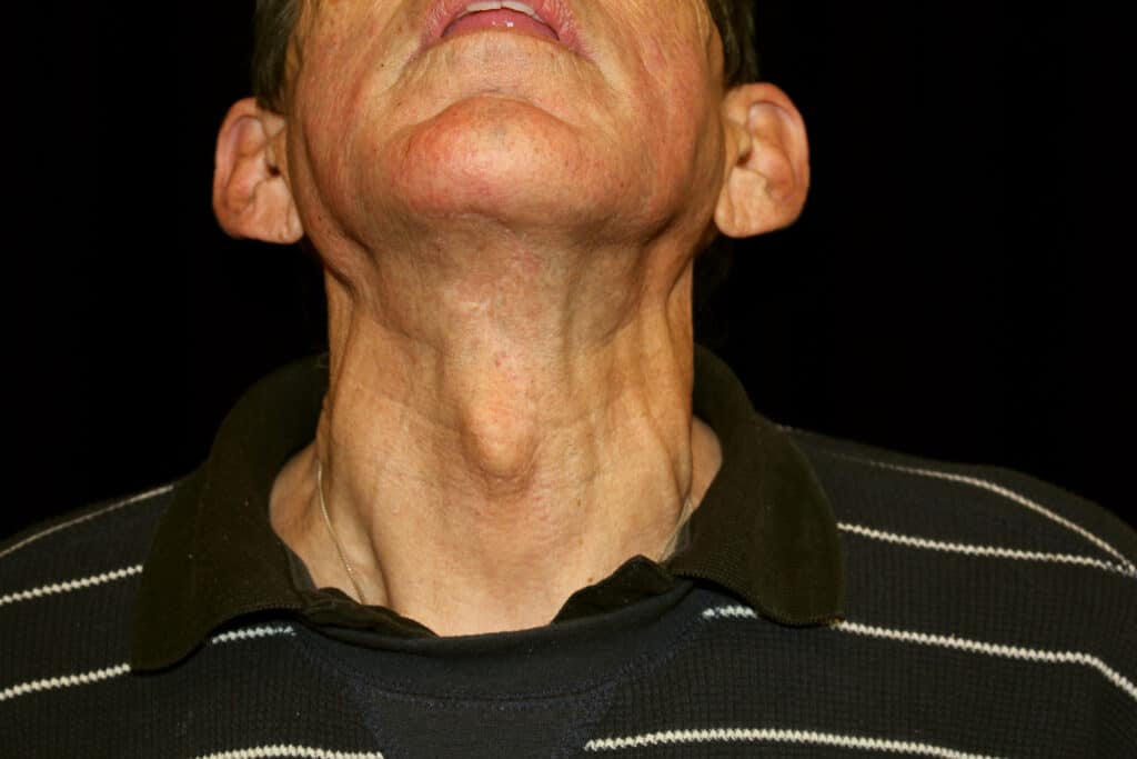 Incision underneath the chin, tightens underlying platysma muscles with a vertical z shaped incision closure