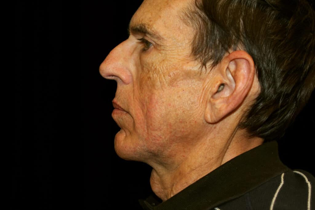  Patient after a chin implant and direct neck lift procedure.