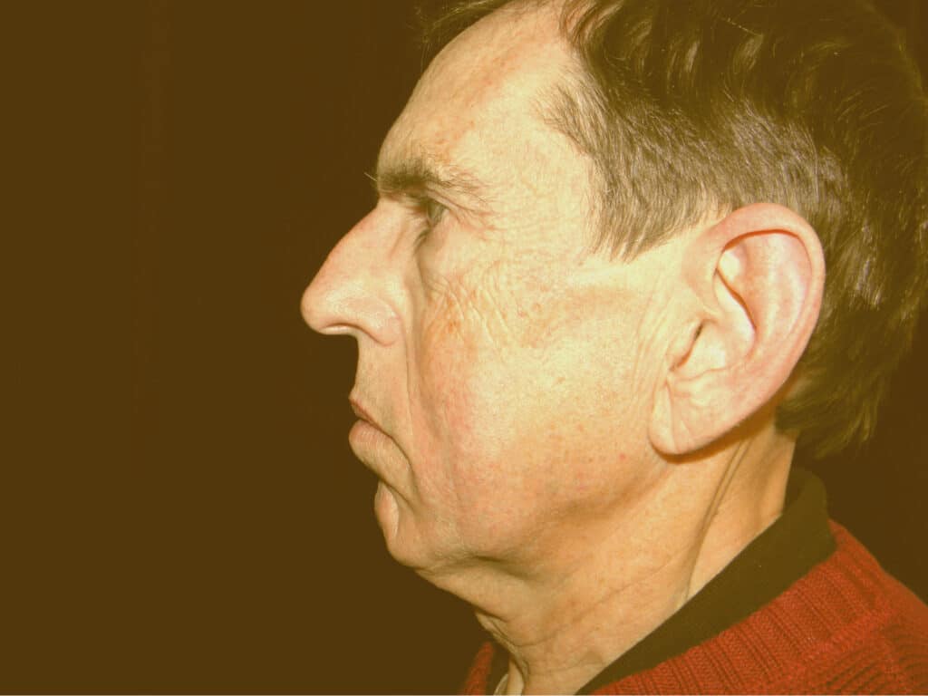 Patient with with a small chin and excess neck skin.