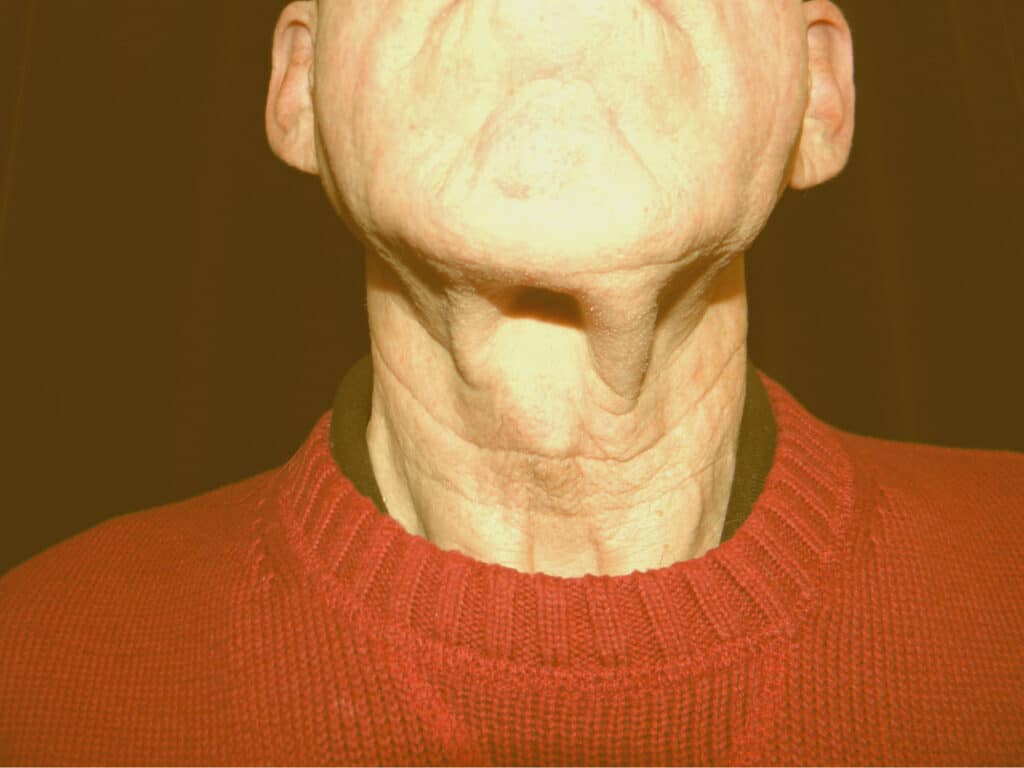 Dr. Delgado San Francisco patient with excess neck skin in the central neck