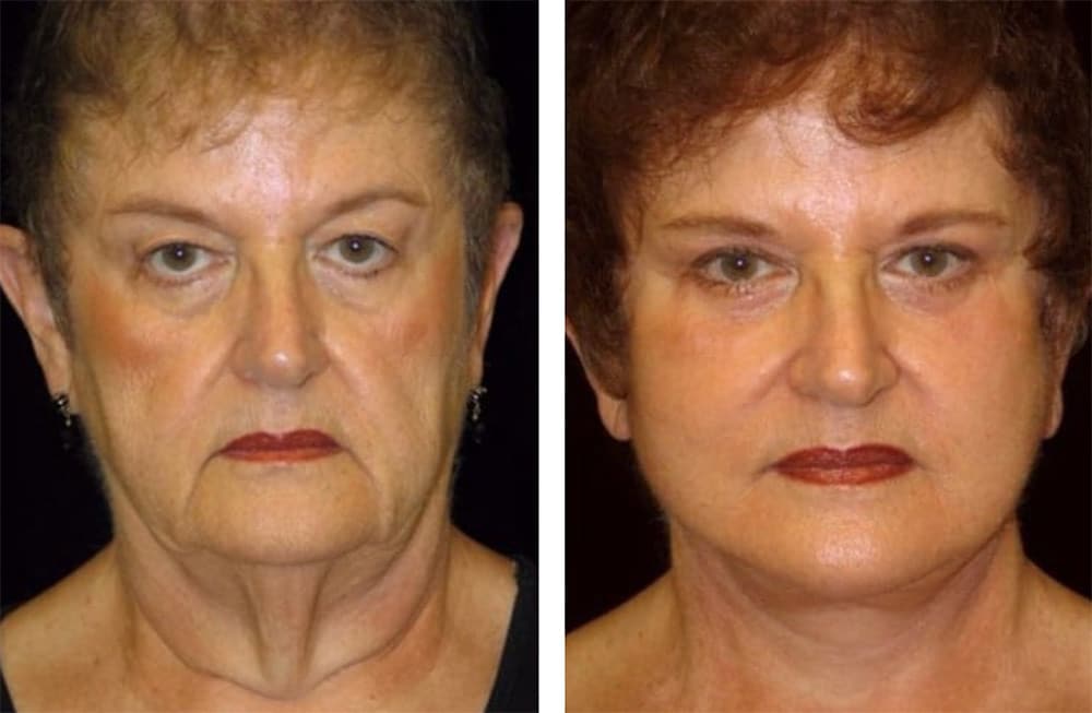 San Francisco plastic surgeon, Dr. Delgado, performs a full facelift and fat injections for fat volume replacement.
