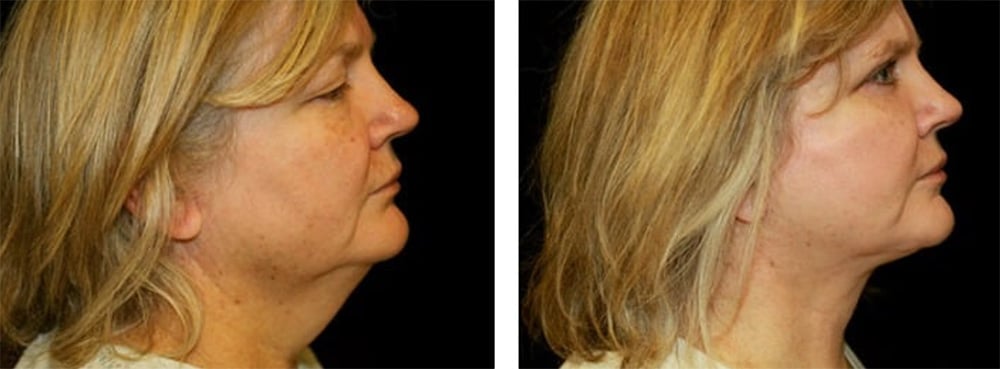Patient facelift Before and after photo