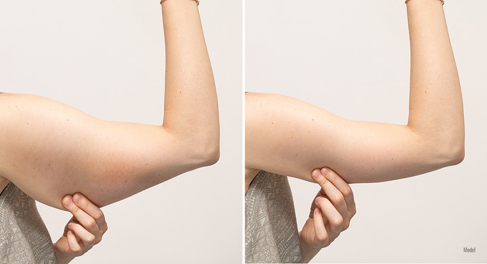 Before and After photos of Armlift