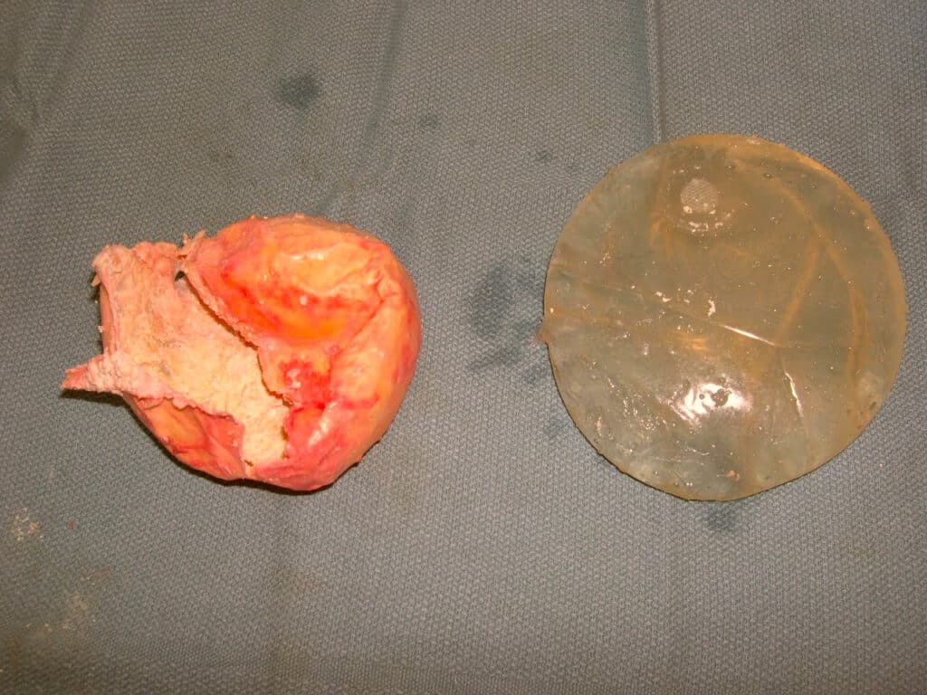 Severe breast capsule with implant removed