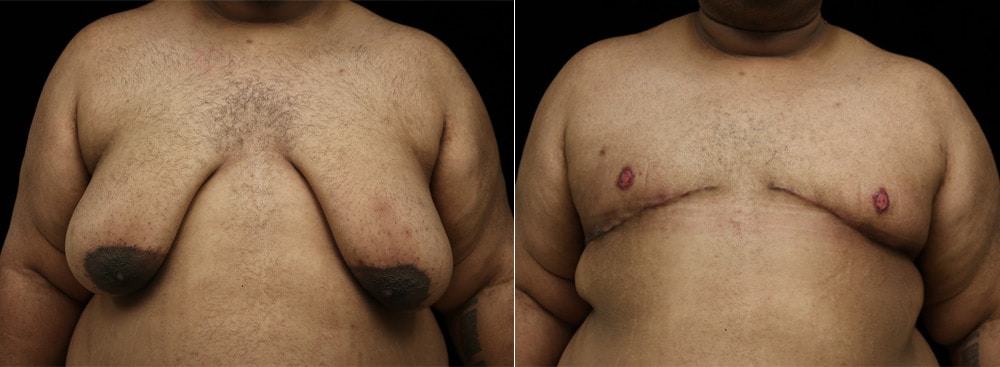 Male patient of Dr. Delgado with excess skin and gynecomastia after moderate weight loss.
