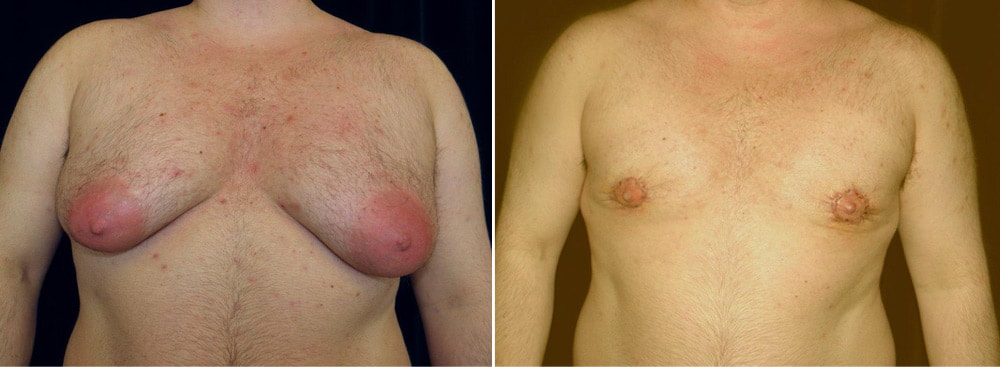 Gynecomastia before and after photo