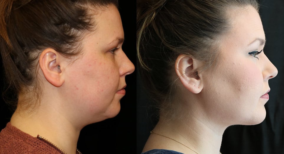 Before and After photo of Neck lift surgery