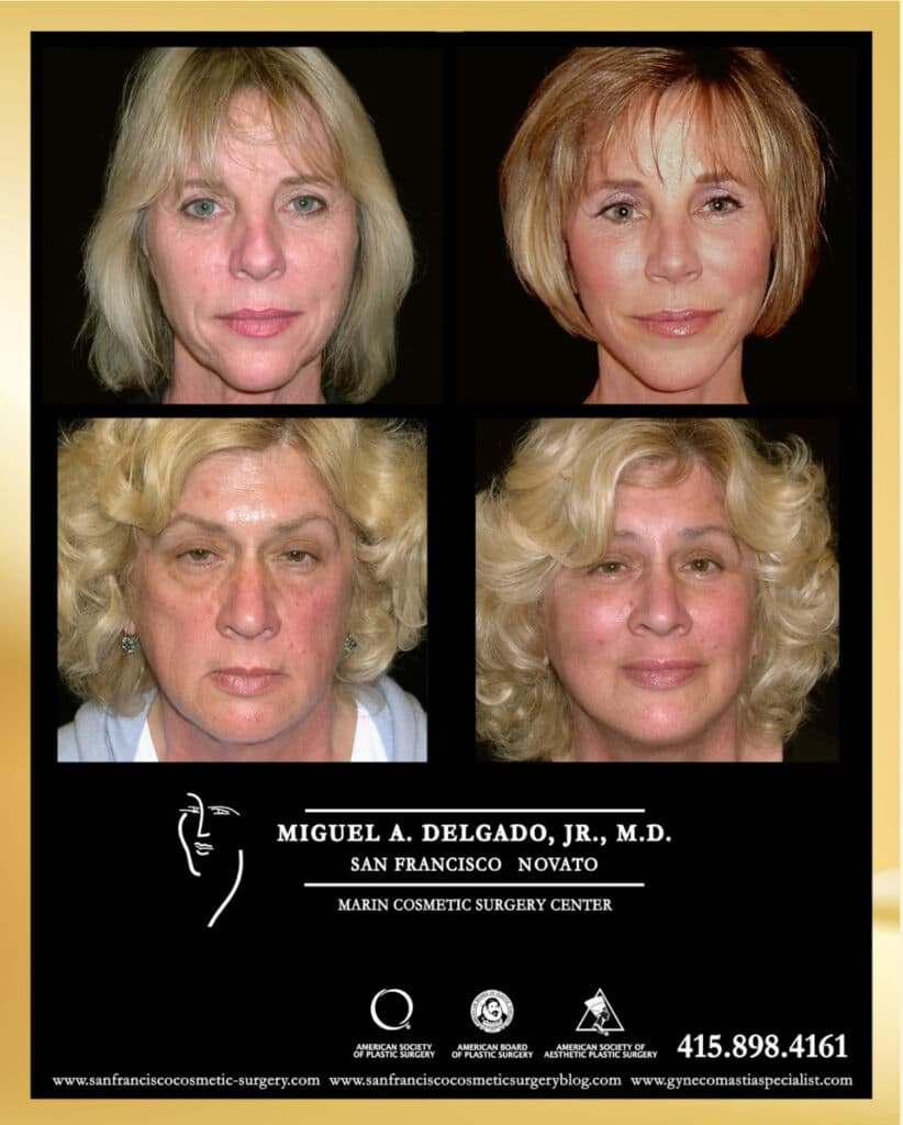 Before and After photo of Facelift and Neck lift