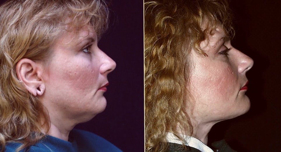 Before and After photo for Neck lift patient