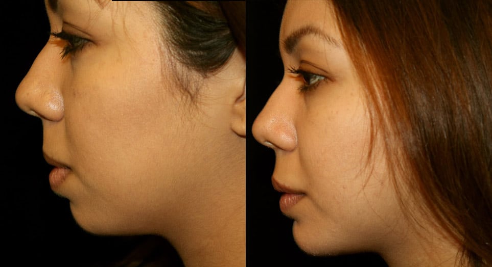 Patient of Dr. Delgado's with excess skin, sagging skin, and poor skin elasticity.