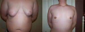 An illustration of the surgical procedure for gynecomastia treatment.