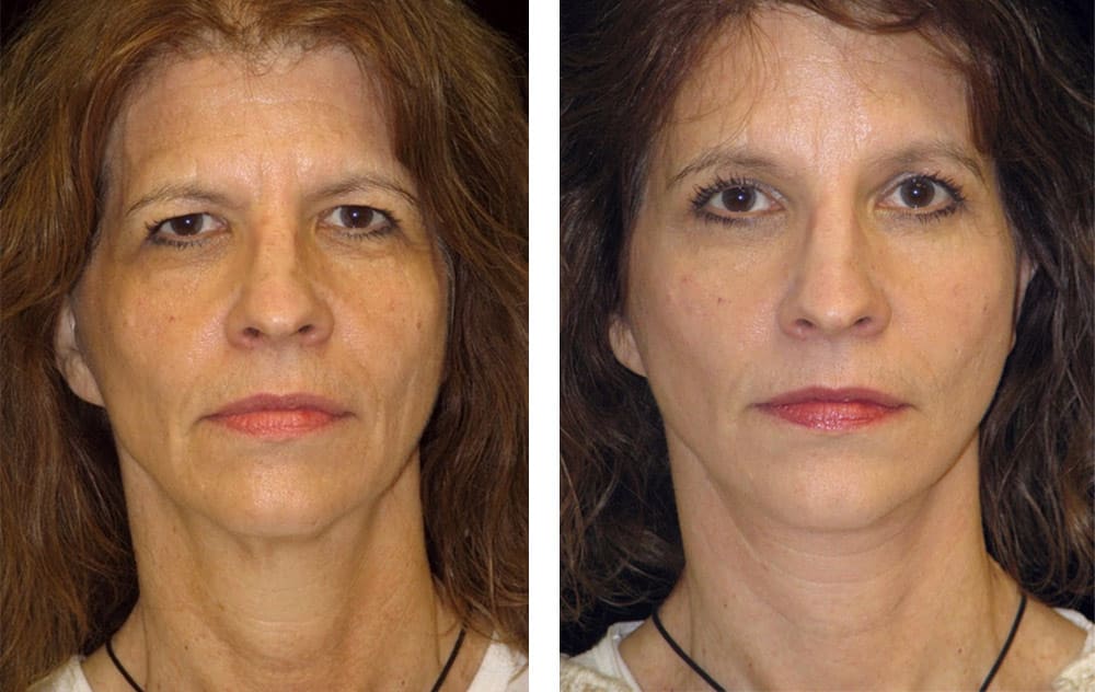 Patient after a facelift, eyebrow lift and eyelid lift with fat injections.