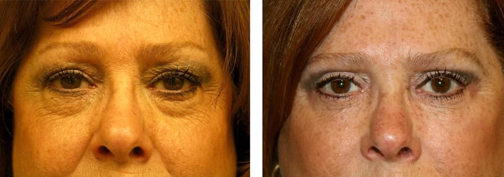 Patient after a upper and lower blepharoplasty.