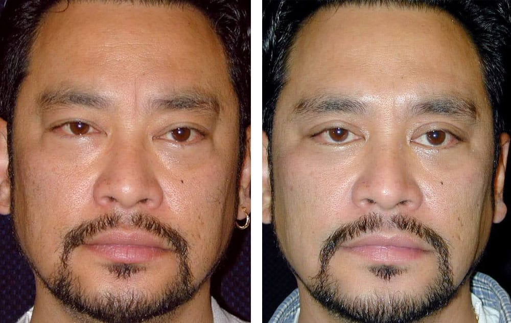 Patient after a browlift and eyelid lift (blepharoplasty).