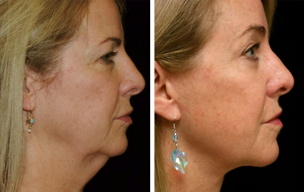 Patient after a lower face and neck lift.