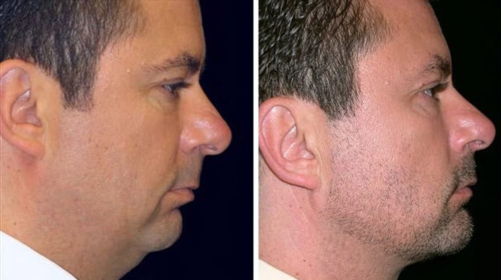  Male patient with a small chin and fatty neck. After a chin implant and neck liposuction.