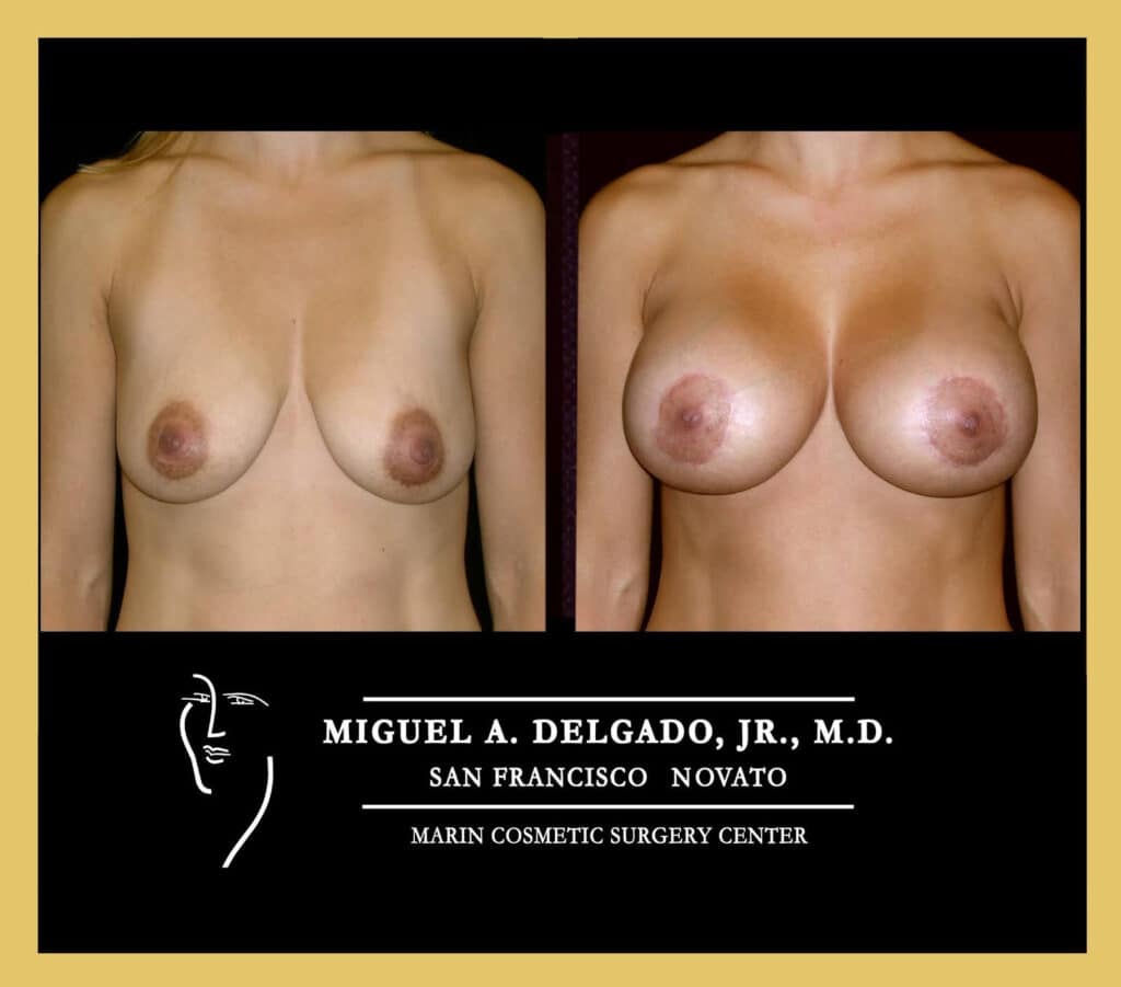 breast Augmentation before and after photo