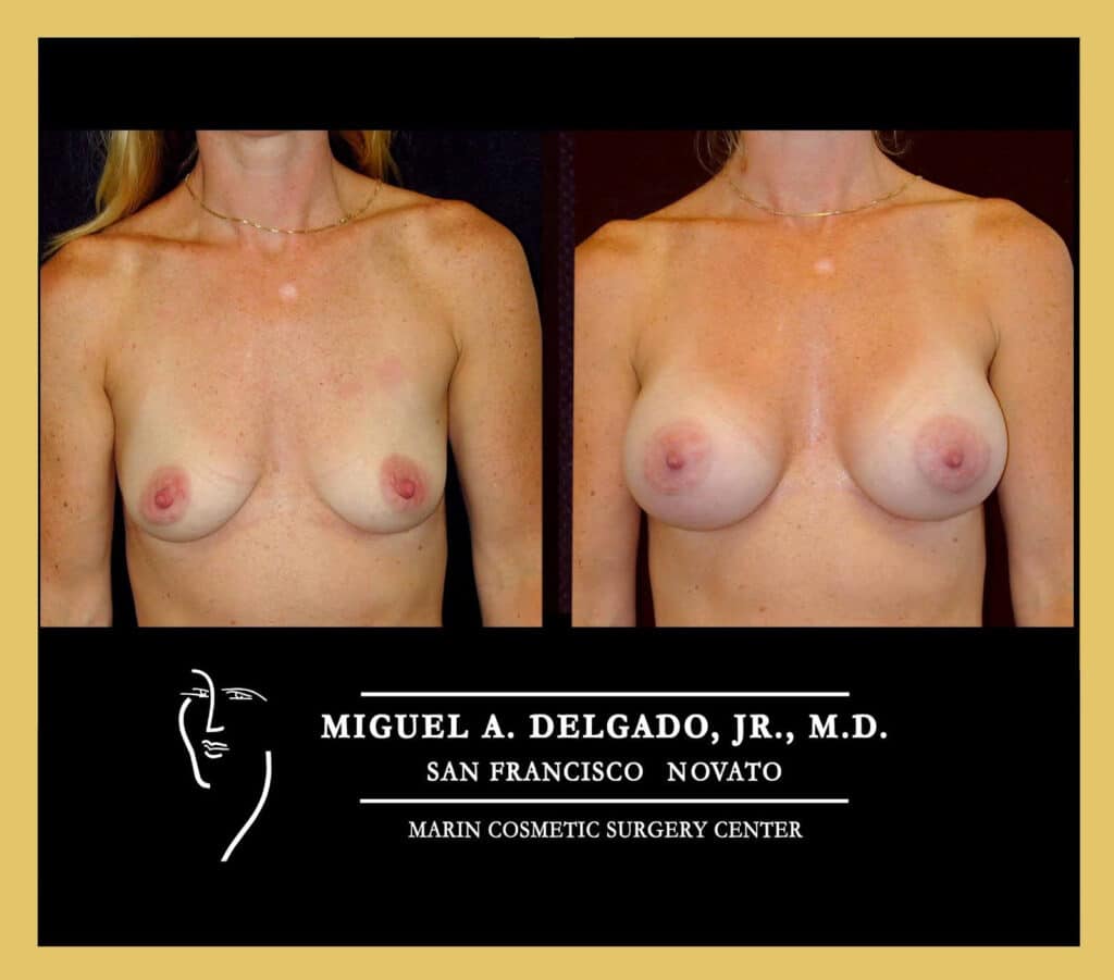 Breast Augmentation Before and After photo 