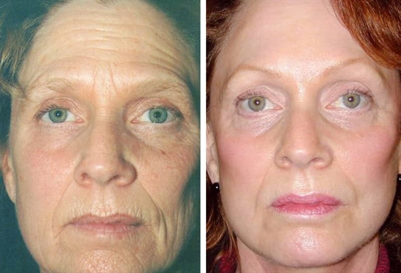 Before and after photo of deep plane facelift, eyelid lift and chemical peel 10 years later.