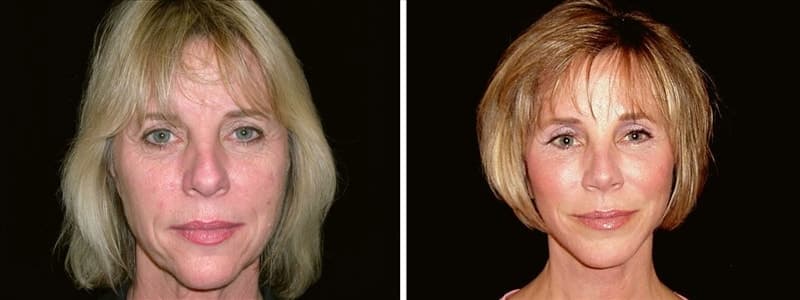 Patient after a deep plane facelift, eyelid lift, brow lift, chin implant replacement, nasal tip-plasty, chemical peel. 