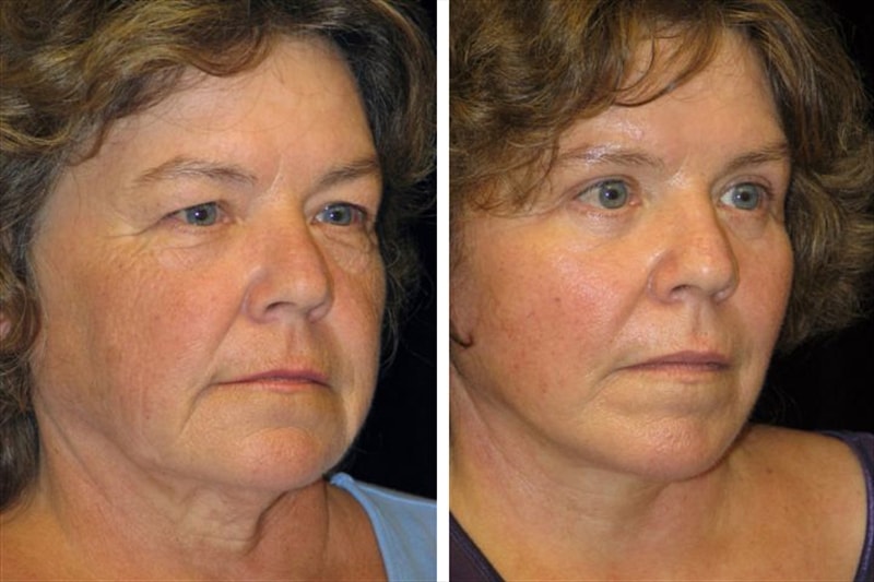 Before and after photo of deep plane lift with eyelid lift or blepharoplasty, eyebrow lift and chemical peel.