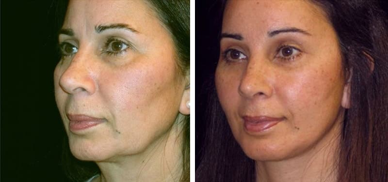 Before and after photo after a deep plane facelift and eyelid lift(blepharoplasty).