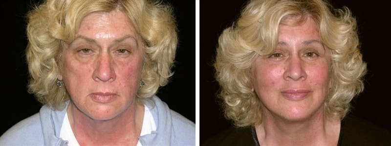 Before and after photo of deep plane facelift, fat grafting, eyelid lift and brow lift.