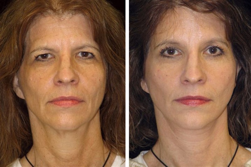 Before and after images showcasing the benefits of deep plane facelift with eyelid lift and brow lift.